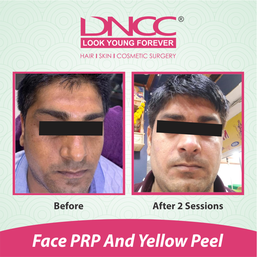 Hair Transplant Transformation 1